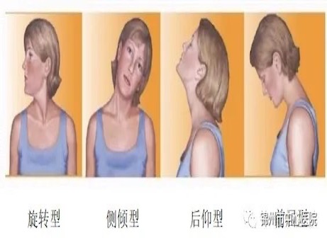 創(chuàng)新技術(shù)｜肉毒毒素治療痙攣性斜頸填補遼西地區(qū)空白