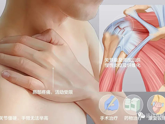 我們一起來認(rèn)識肩周炎