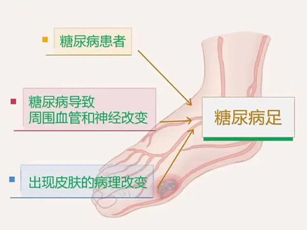 優(yōu)勢學科｜糖尿病足 預防大于治療 隨訪同樣重要