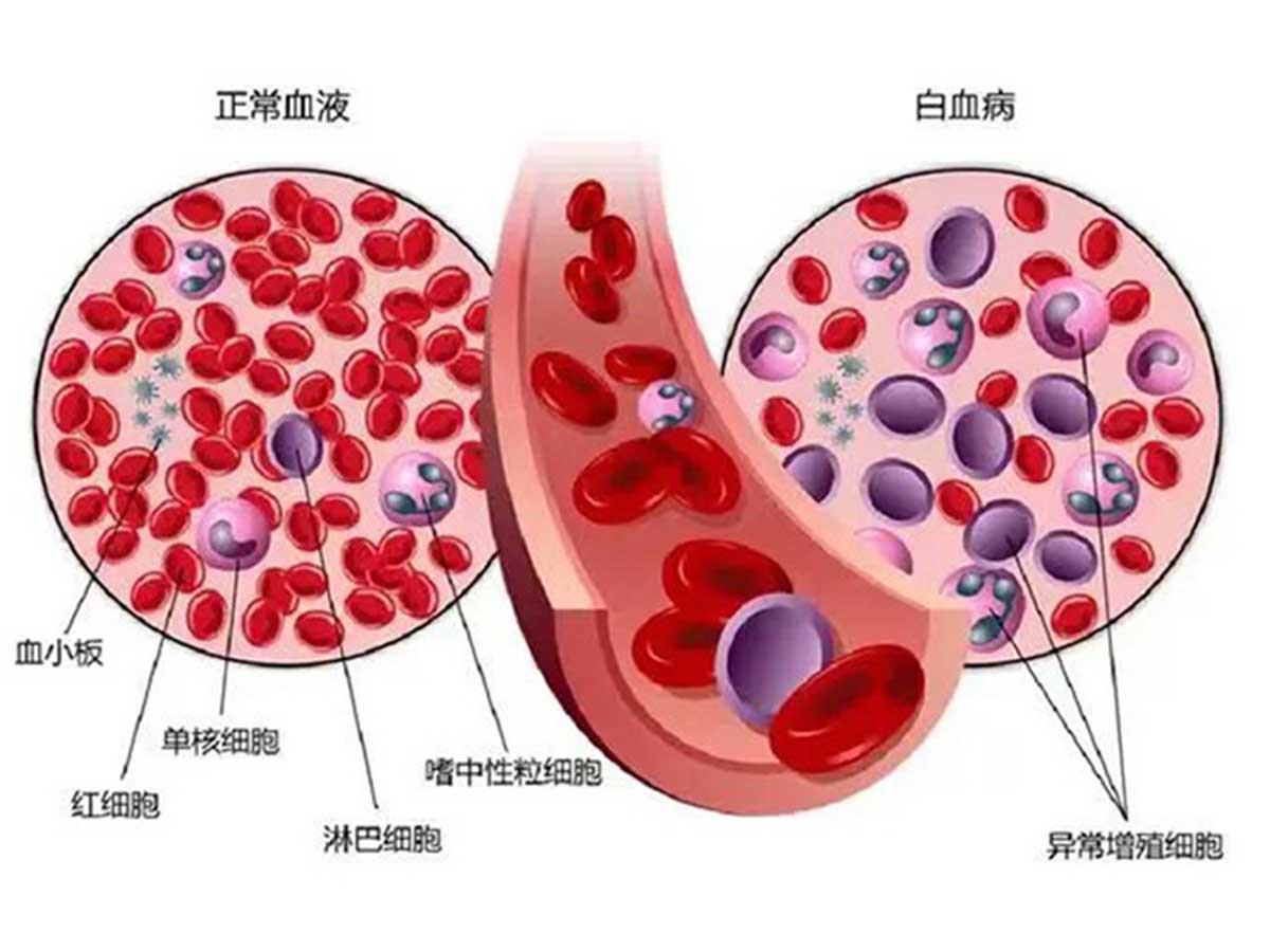 優(yōu)勢學(xué)科｜多學(xué)科合作 個體化治療 為老年高危急性髓系白血病合并壞疽性膿皮病患者帶來希望