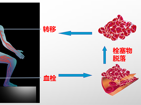 優(yōu)勢(shì)學(xué)科|錦州市中心醫(yī)院心血管內(nèi)三科成功救治一名高危肺動(dòng)脈栓塞患者