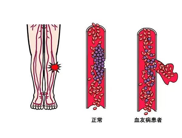 健康宣教 | 規(guī)范診療 預(yù)防出血——錦州市中心醫(yī)院血液科血友病患教會